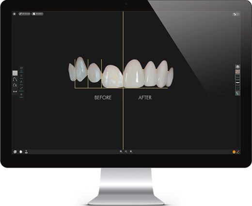 smile-design-mac alt="Smile Makeover Design Software"