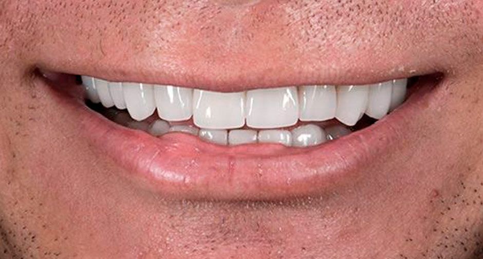 Smile Makeover after