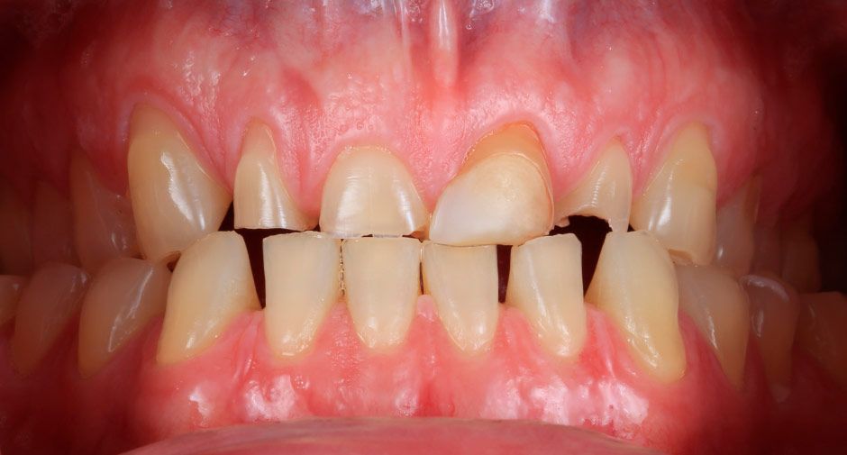 Root canal therapy treatment before