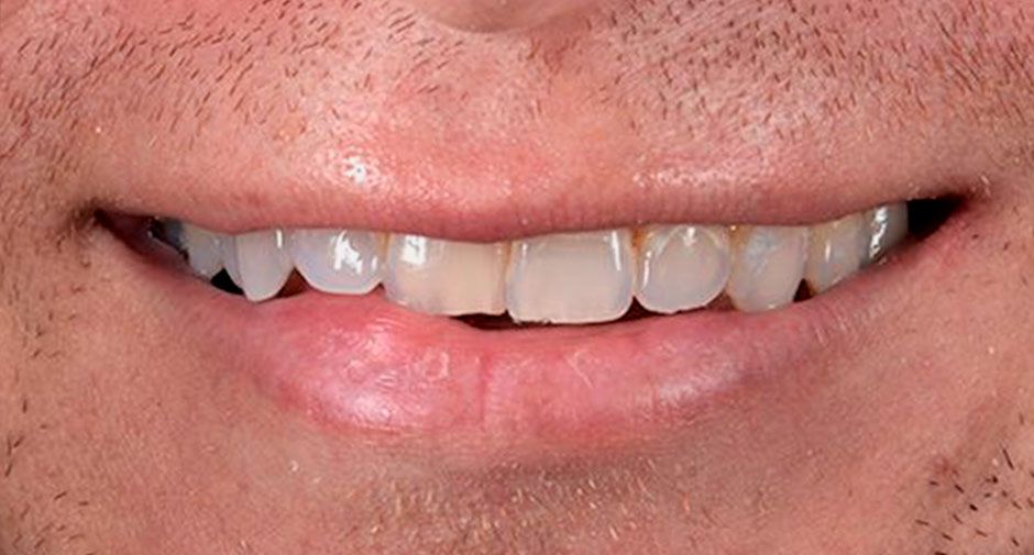 Smile Makeover before