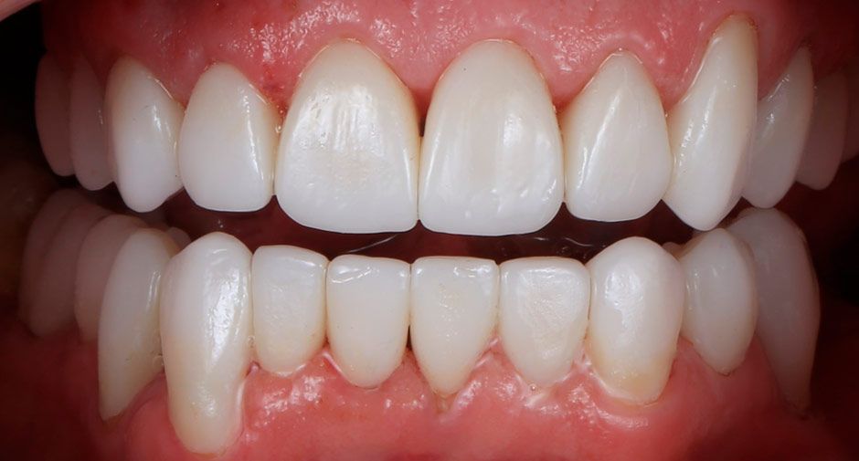 After Dental Veneers