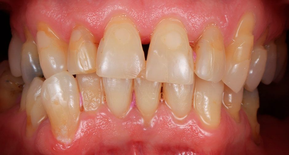 Before Dental Veneers