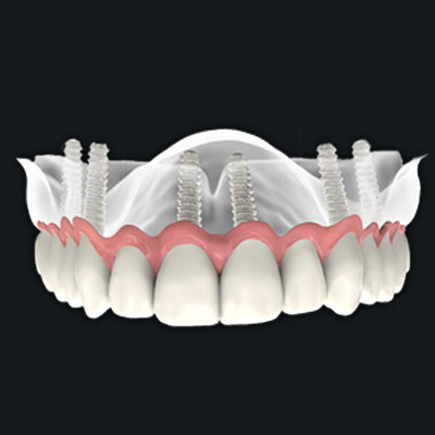 Snap on Dentures Smile Makeover