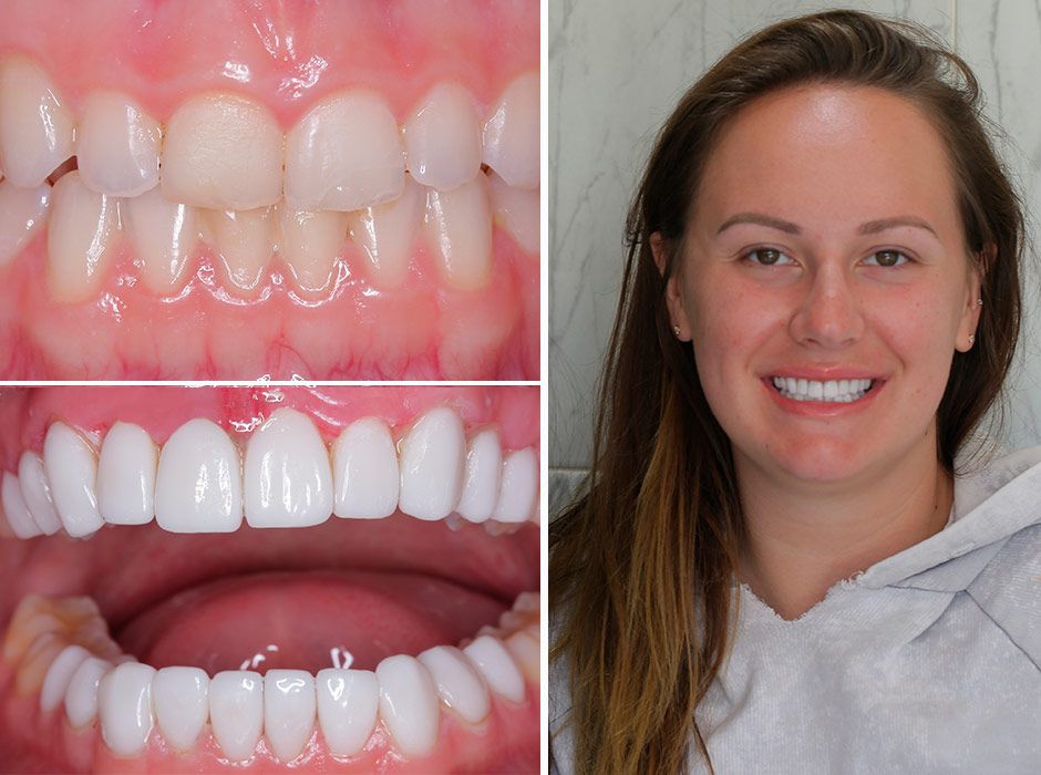 Smile Makeover México dental veneers