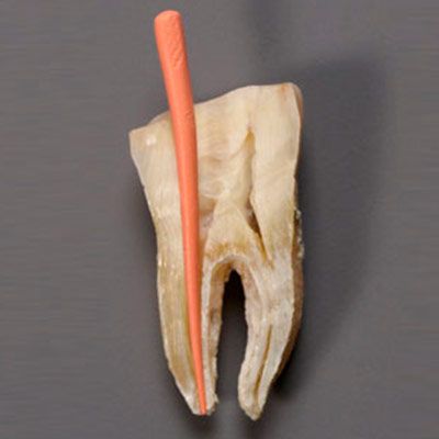 Root Canal Therapy process