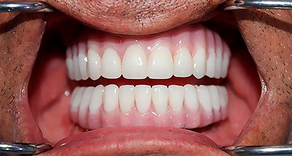 All on 4 Smile Makeover Mexico dental treatment