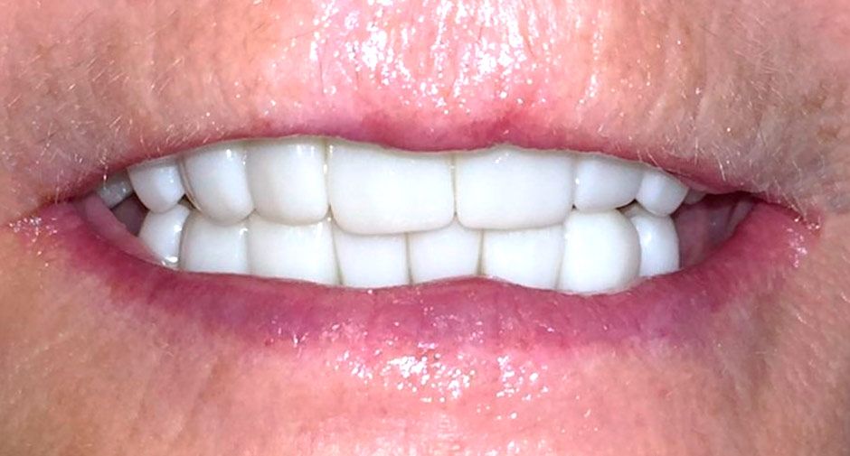 After crowns Smile Makeover Mexico