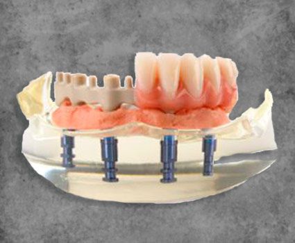 All on 4 Smile Makeover Mexico