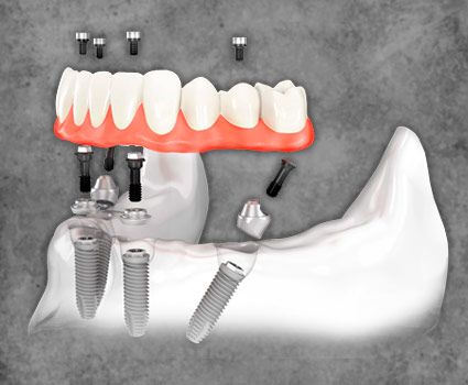All on four Mexico Smile Makeover