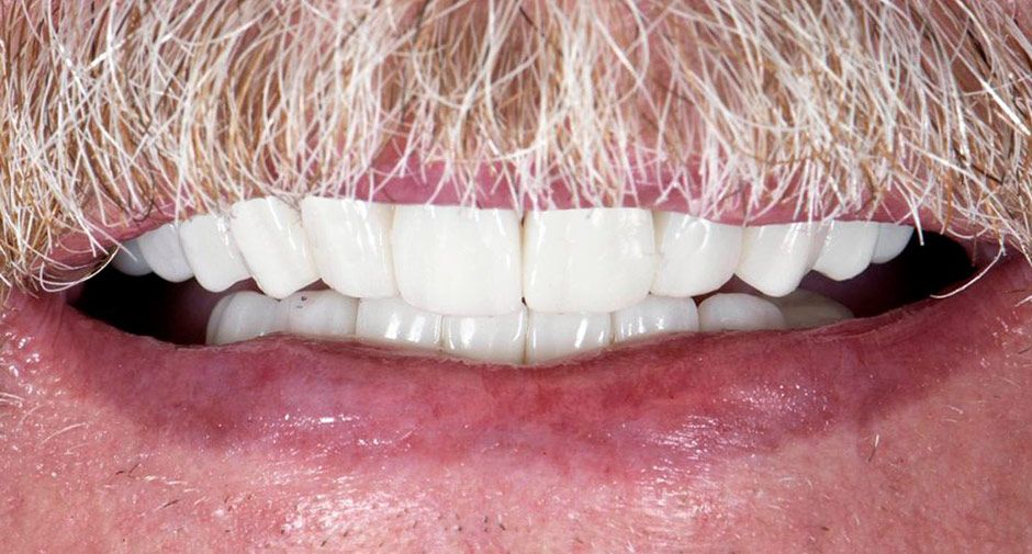 Smile Makeover Recovery dental implants