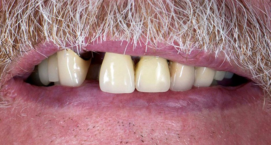 Full Mouth restoration Mexico