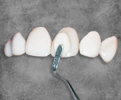 Composite veneers Mexico