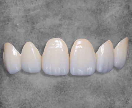 best porcelain veneers Mexico