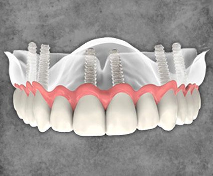 Snap on dentures Mexico