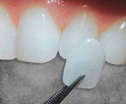 Zirconia Veneers Smile Makeover