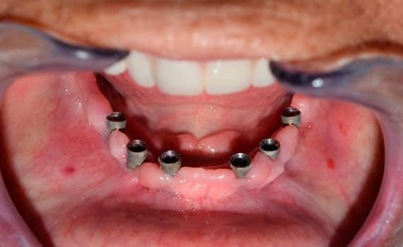 6-dental-implants Process 3 on 6 implants Step 2