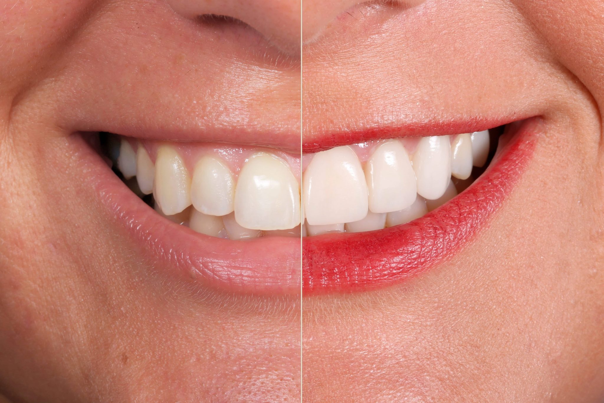 Mexico Dental Veneers ⋆ Smile Makeover Playa del Carmen