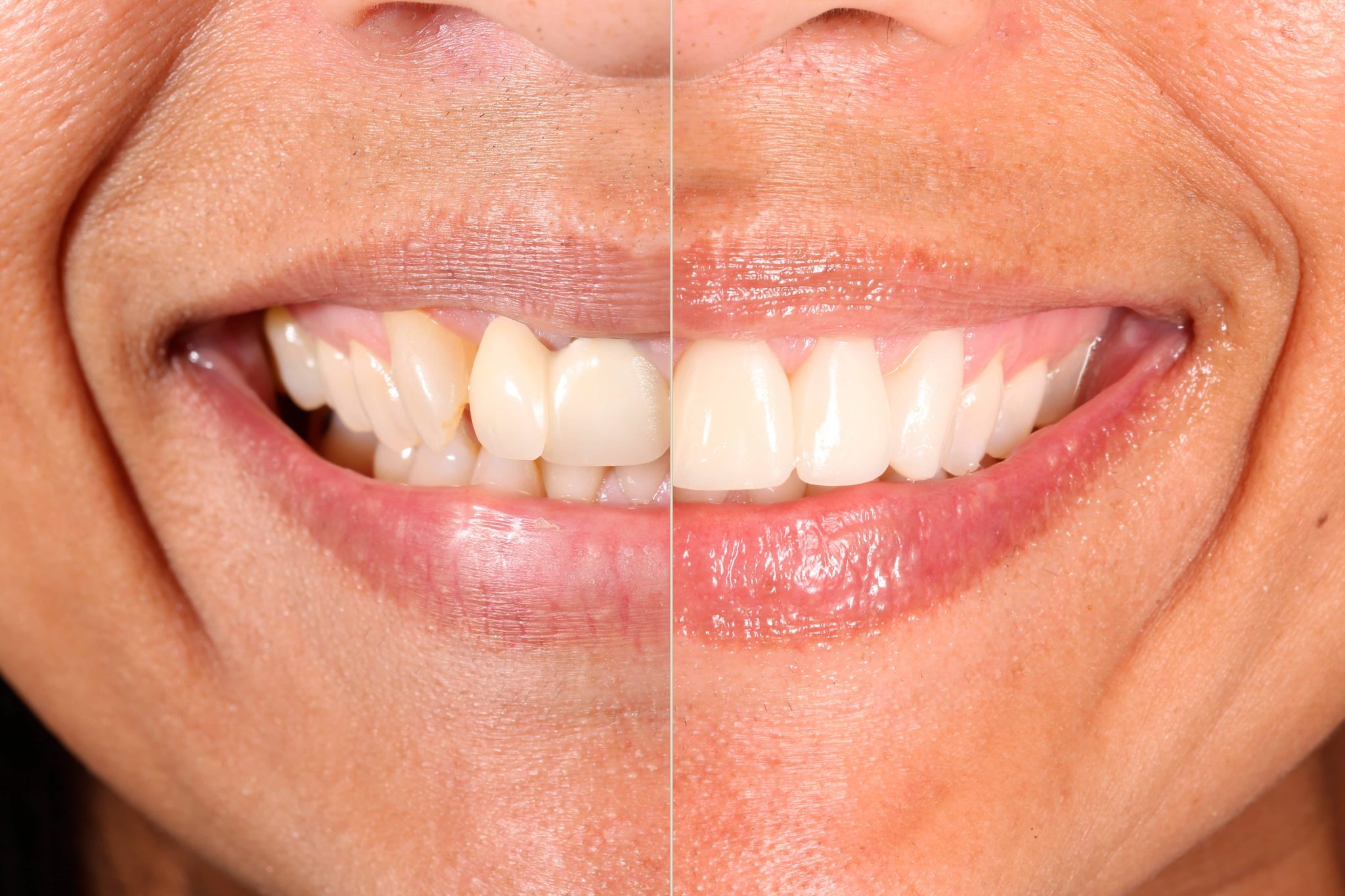 Mexico Dental Veneers ⋆ Smile Makeover Playa del Carmen