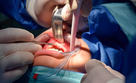 dental-extraction Process 3 on 6 implants Step 1