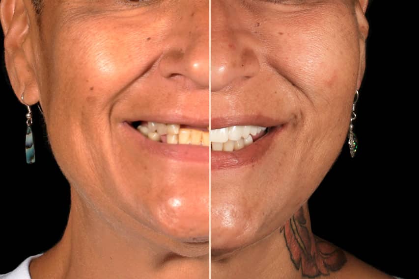 Titanium Dental Implants