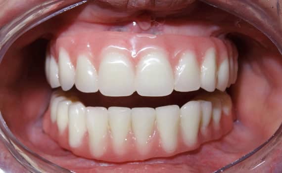temporary-denture-dental-implants