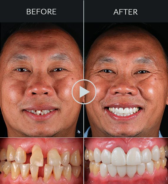 before-and-after-dental-work-mexico Smile Makeover Playa del Carmen