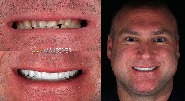 Dental implants Playa del Carmen
