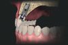 Dental Implants step by step