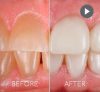 Before & After Smile Makeover Mexico