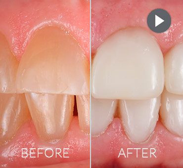 dental-work-smile-makeover-in-mexico Before & After Smile Makeover Mexico