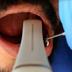 Procedure veneers