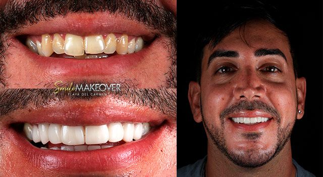 Smile design Mexico affordable prices
