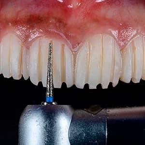 Procedure veneers in Mexico