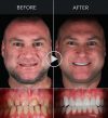 Smile Makeover in Mexico dental clinic