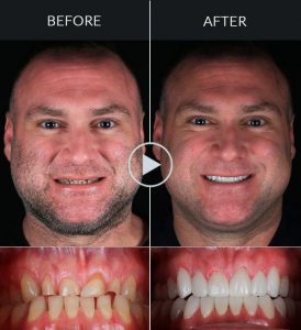 Smile Makeover Mexico ⋆ Dental Makeover ⋆ Playa del Carmen Dentist