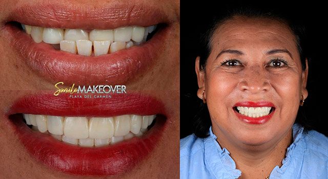 Smile Makeover Mexico affordable prices