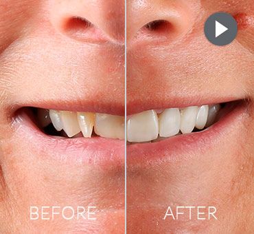 smile-makeover-playa-del-carmen-dental-work Dental solutions at Smile Makeover