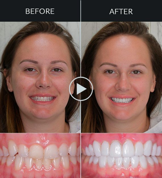smile-makeover-recovery-dental-treatments Gummy smile correction Mexico