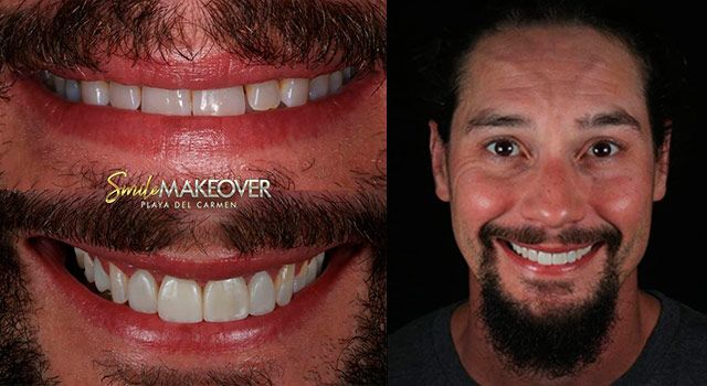 Crowns Mexico dental treatments