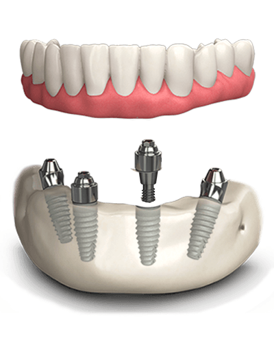 Dental implants All on 4 Mexico