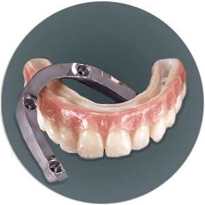 Fixed Hybrid Denture