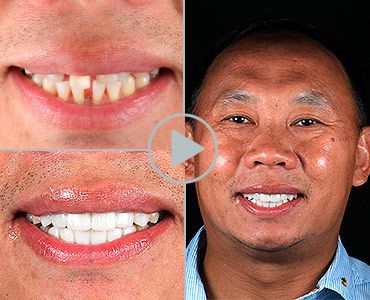 full-mouth-reconstruction-hollywood alt=""