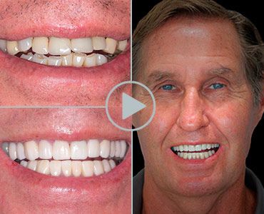 Full Mouth restoration Mexico