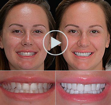 smile makeover playa del carmen reviews